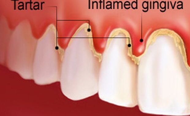 gingivitis-kamenac