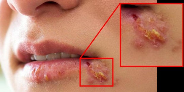 herpes-usna (1)
