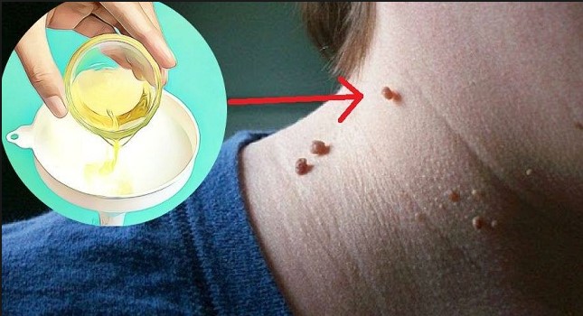 Kako-ukloniti-sve-vrste-bradavica-sa-vašeg-tijela-u-nekoliko-minuta-koristeći-jednu-namirnicu-iz-vaše-kuhinje
